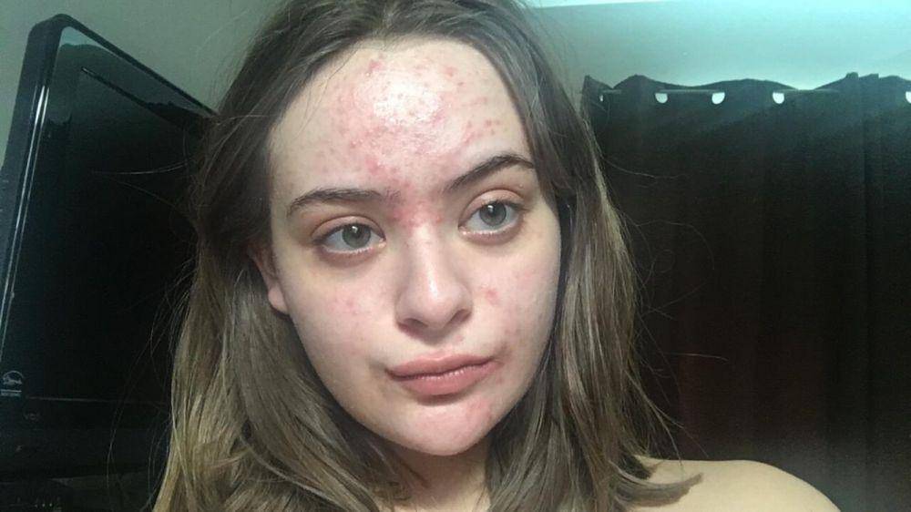 acne.org