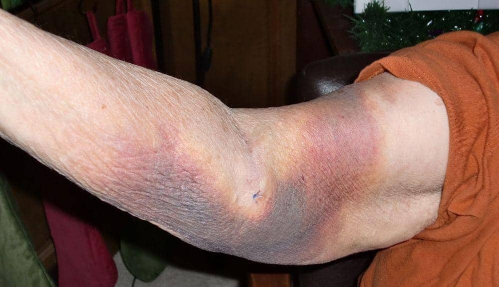 fibrinogenamyloidosis.com