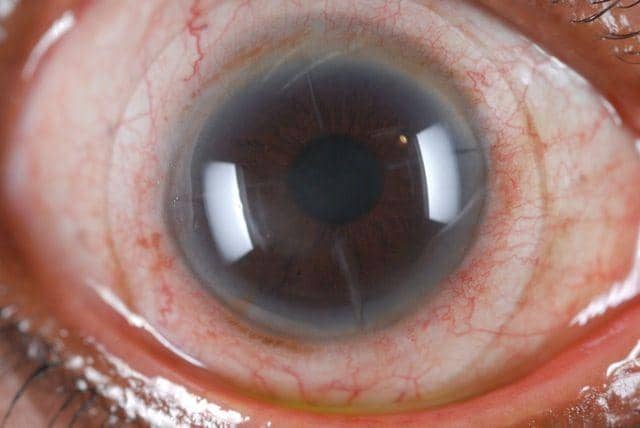 lasikcomplications.com