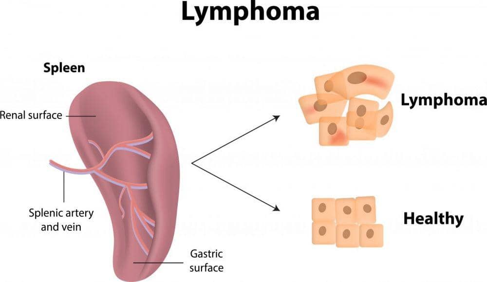 lymphomanewstoday.com