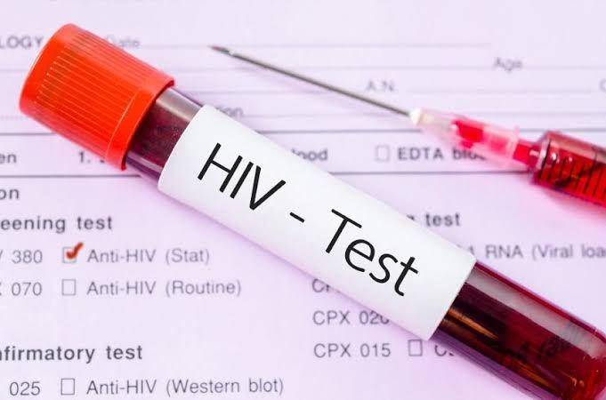 hiv aids