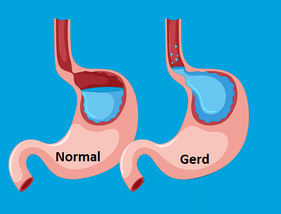asamlambunggerdanxiety