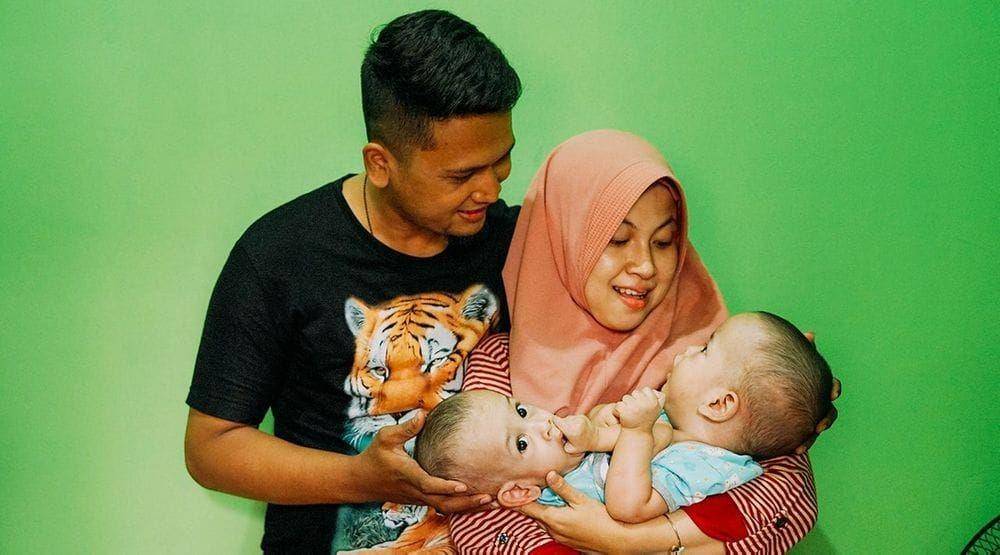 (Bayi kembar siam Ardi dan Ardan akan menjalani operasi pemisahan di RSAB Harapan Kita) Dok. Istimewa