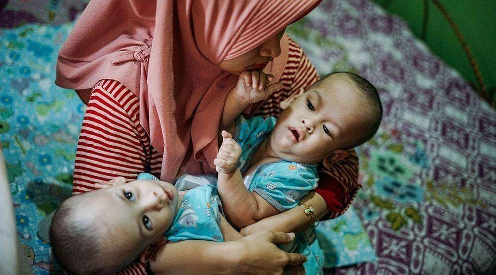 (Bayi kembar siam Ardi dan Ardan akan menjalani operasi pemisahan di RSAB Harapan Kita) Dok. Istimewa