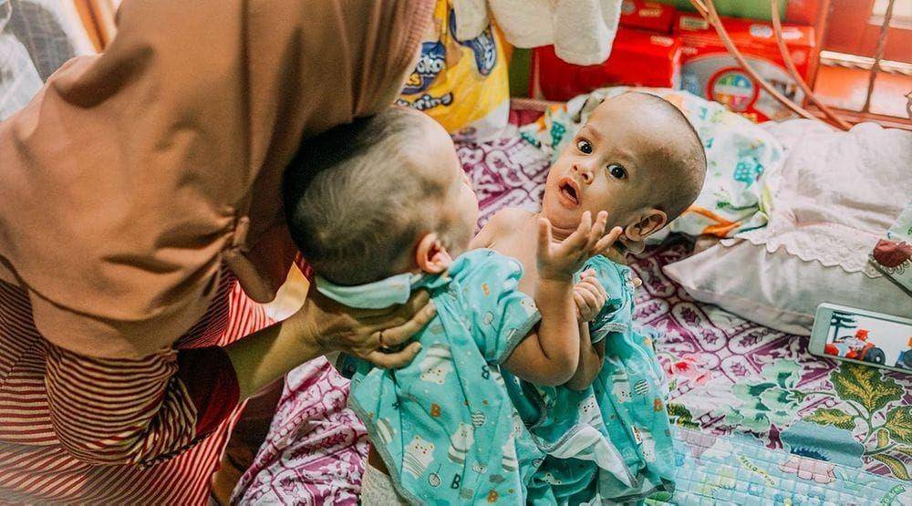 (Bayi kembar siam Ardi dan Ardan akan menjalani operasi pemisahan di RSAB Harapan Kita) Dok. Istimewa