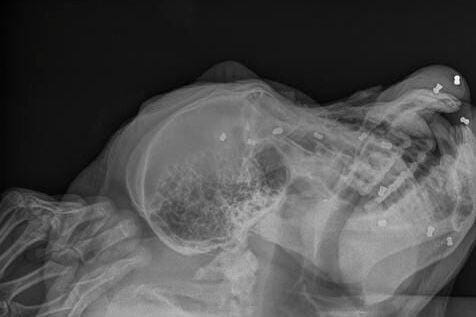 Hasil pemindaian sinar X menunjukkan 24 peluru bersarang di tubuh Paguh (dok YEL-SOCP)