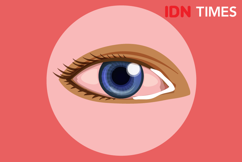 Ilustrasi konjungtivitis alergi. IDN Times/Izza Namira