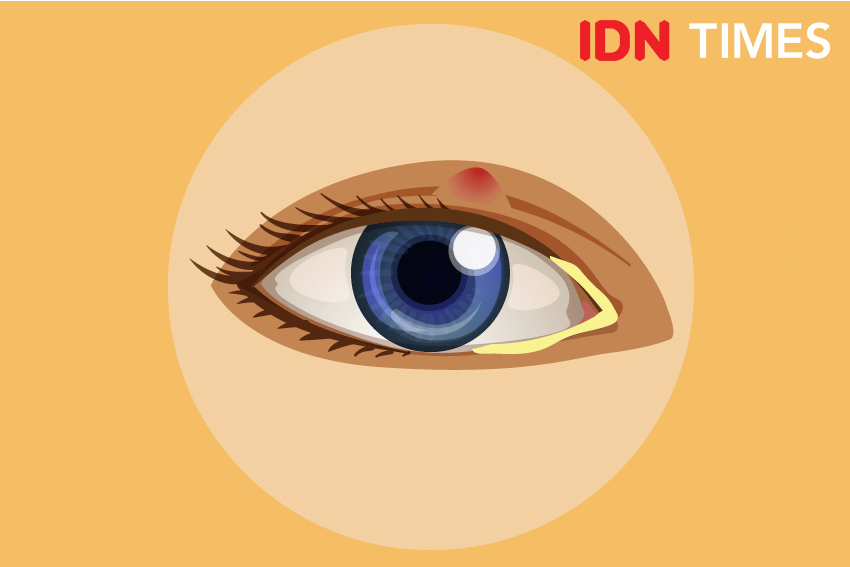 Ilustrasi bintitan. IDN Times/Izza Namira