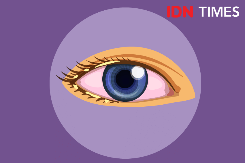 Ilustrasi blepharitis IDN Times/Izza Namira