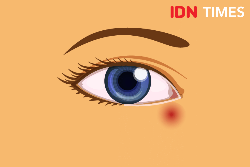 Ilustrasi dakriositis. IDN Times/Izza Namira