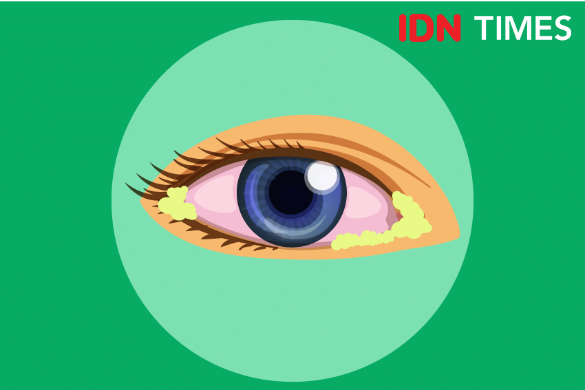 Ilustrasi disfungsi kelenjar meibom, IDN Times/Izza Namira