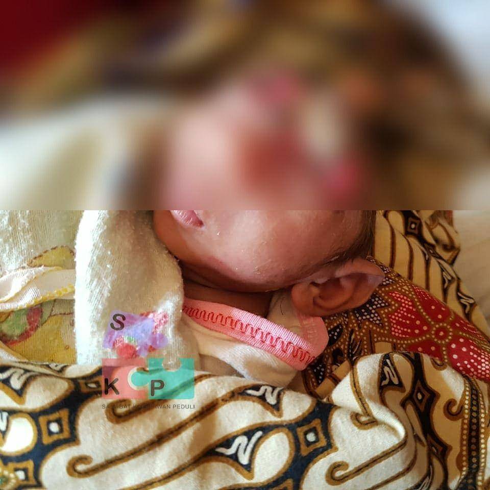 Bayi berusia 29 hari didiagnosa menderita Anensefali (Dok. Istimewa)