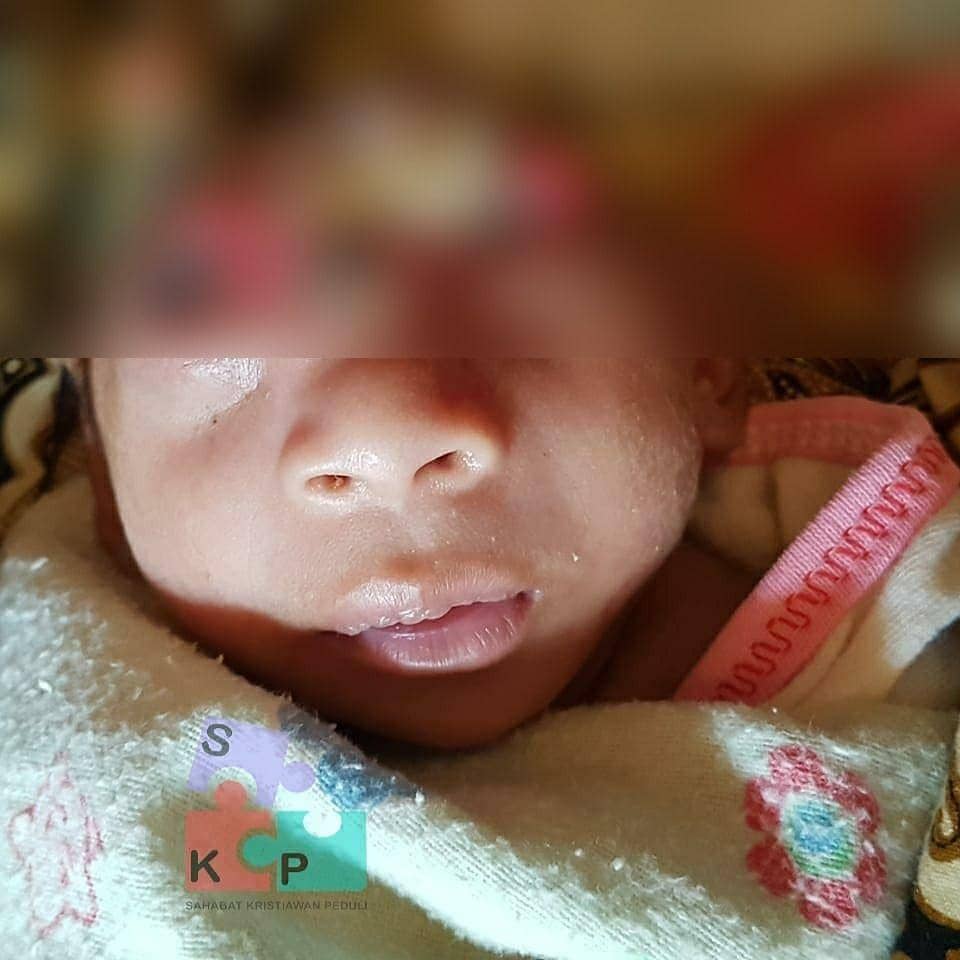 Bayi berusia 29 hari didiagnosa menderita Anensefali (Dok. Istimewa)