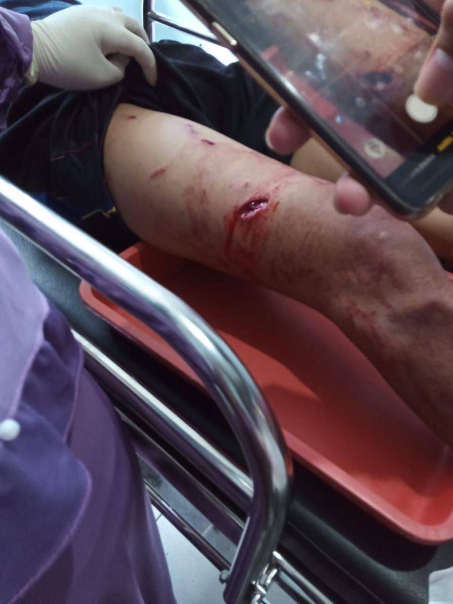 Kaki dari Marta Rulani Bin Alfian (24) warga Desa Tebat Benawa, Kecamatan Dempo Selatan, Pagaralam, yang diterkam harimau saat lagi di kebun kopi, Senin (2/12)/IDN Times/Istimewa