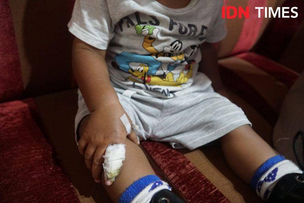 (Korban gigitan ikan Aligator Lapas Perempuan Sukamiskin) IDN Times/Dok Pribadi