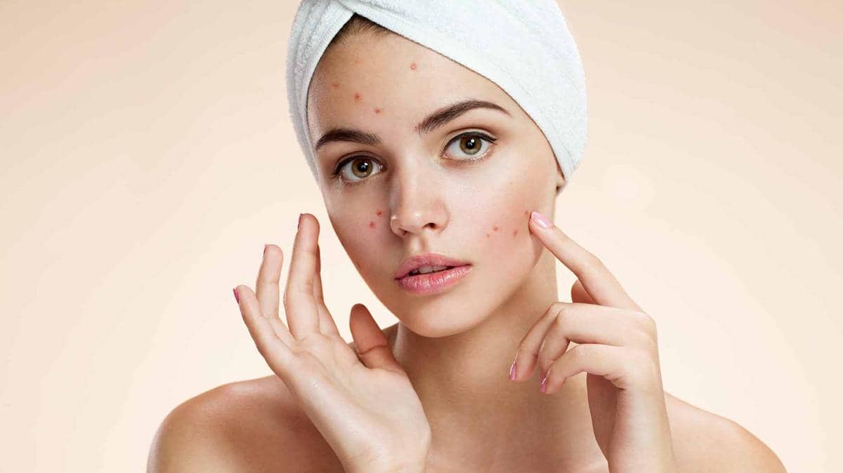 http://cdn.idntimes.com/content-images/post/20160816/acne-natural-facial-masks-diy-problem-skin-56a66b8cb4c26108433803de75259f11.jpg