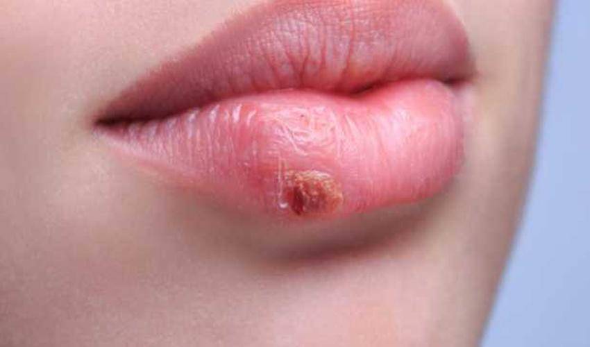 https://cdn.idntimes.com/content-images/post/20161125/herpes-ad539ff4222a335a0d267334b579beb6.jpg