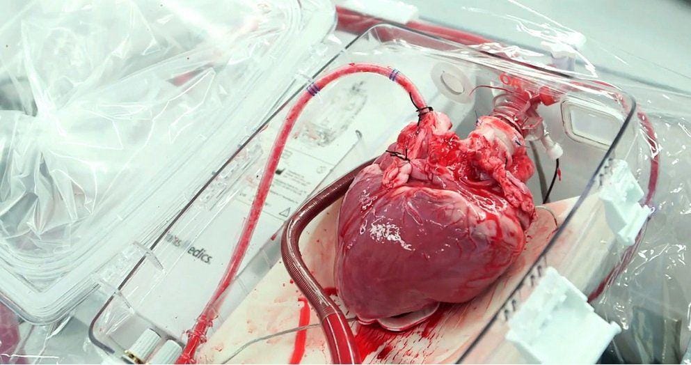 http://cdn.idntimes.com/content-images/post/20151211/man-receives-a-revolutionary-heart-transplant-70fc66ccfdcd63adada503f8608ddb45.jpg