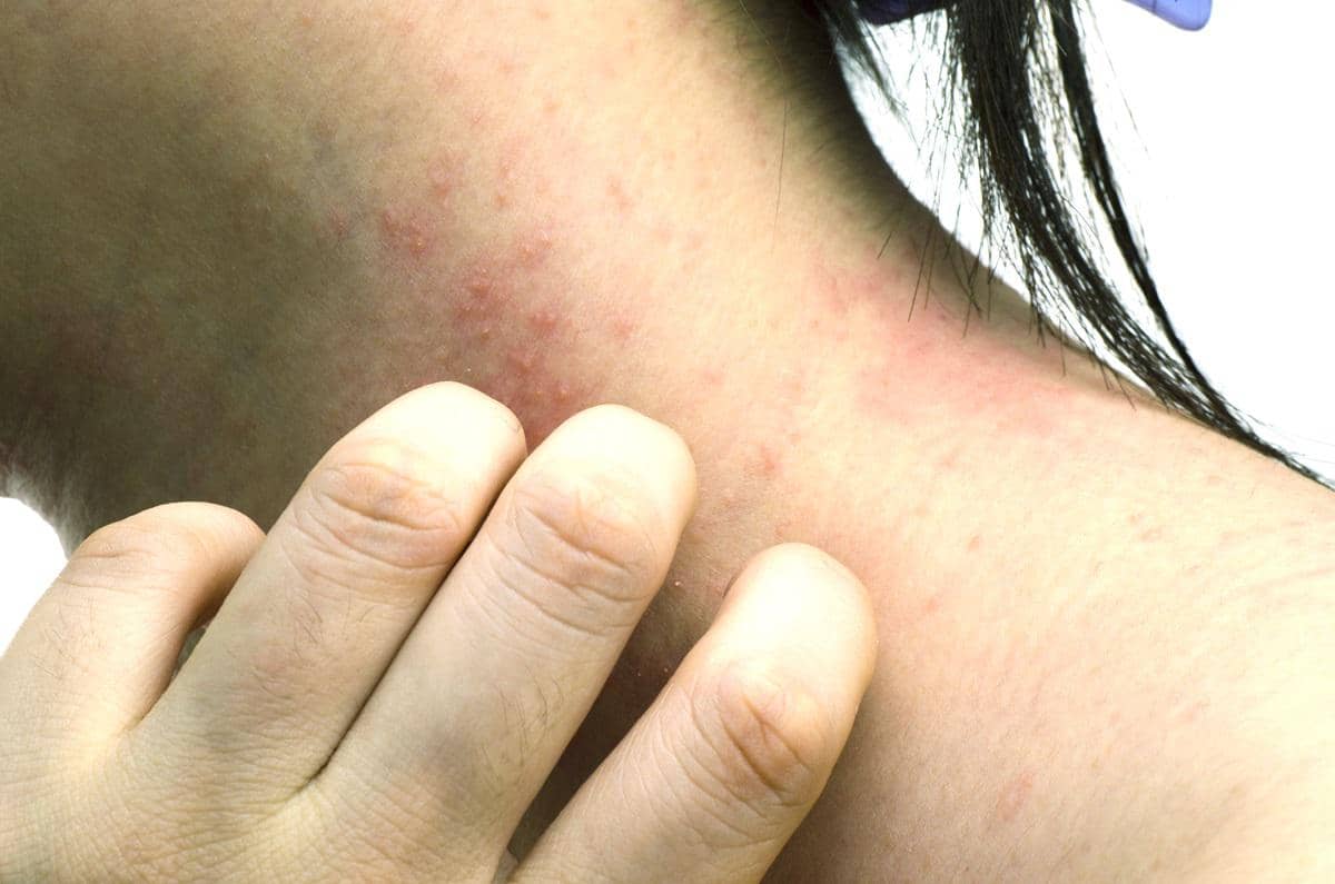 https://cdn.idntimes.com/content-images/post/20170526/dermatitis-393ccf6de07a9ac8c737434a89458dec.jpg