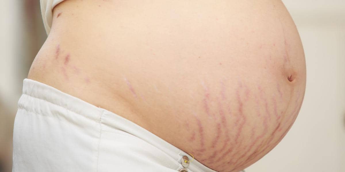 https://cdn.idntimes.com/content-images/post/20170706/o-stretch-marks-pregnancy-facebook-7305aa96bc375ece5f302986bdc7b1db.jpg