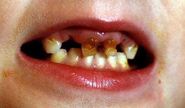 https://cdn.idntimes.com/content-images/post/20170523/rotten-teeth-pictures-theres-a-dentistry-crisis-because-too-many-kids-are-losing-rotten-2ccc627b23e8012af9d213cfa891c1d6.jpg